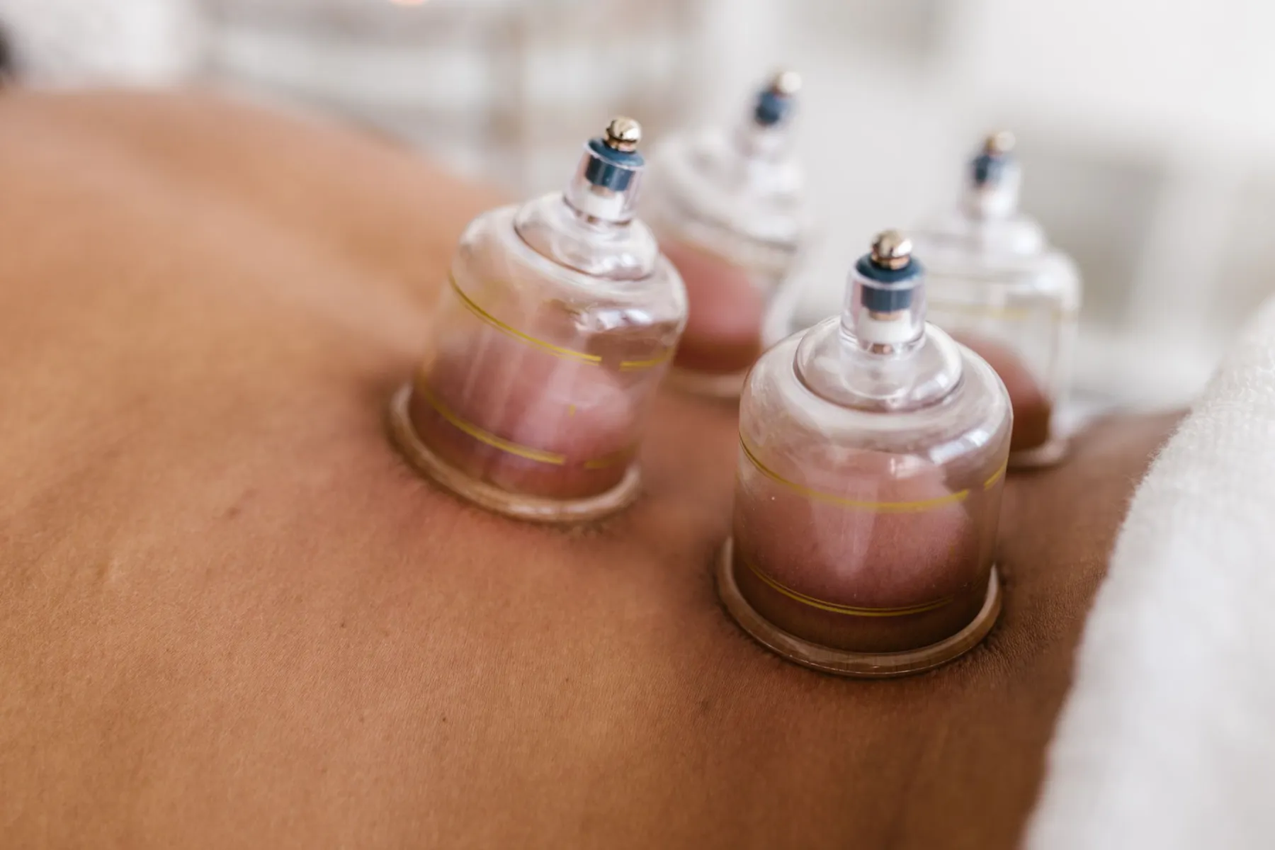 Cupping therapy cups on a person’s back